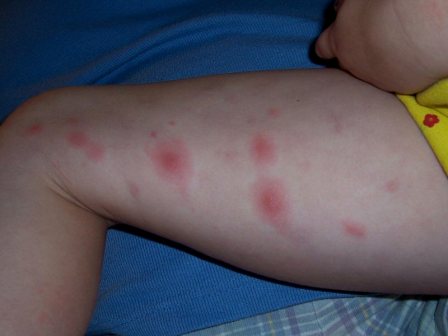 lyme rash in children.jpg